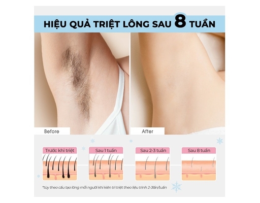 Máy Triệt Lông Lạnh IPL Cooling Hair Removal Device Halio ảnh 3