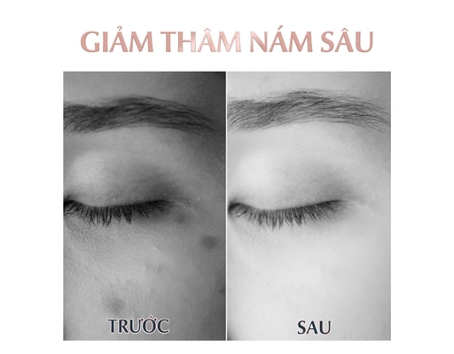 Tinh Chất Giảm Thâm Nám Kiểm Soát Nhờn 30ml Eucerin ảnh 2