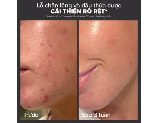 Dung Dịch Loại Bỏ Tế Bào Chết Skin Perfecting 2% BHA Liquid Exfoliant 188ml Paula's Choice ảnh 6